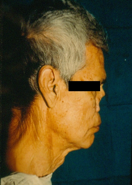 Before-Reconstrucción nasal