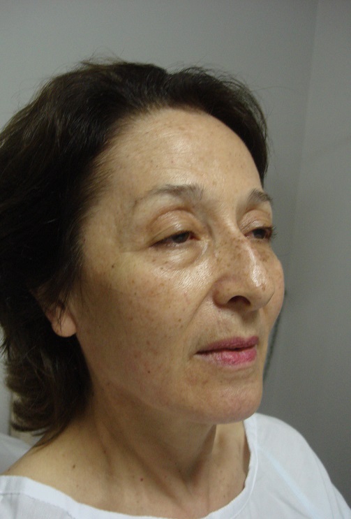 Before-Rejuvenecimiento facial