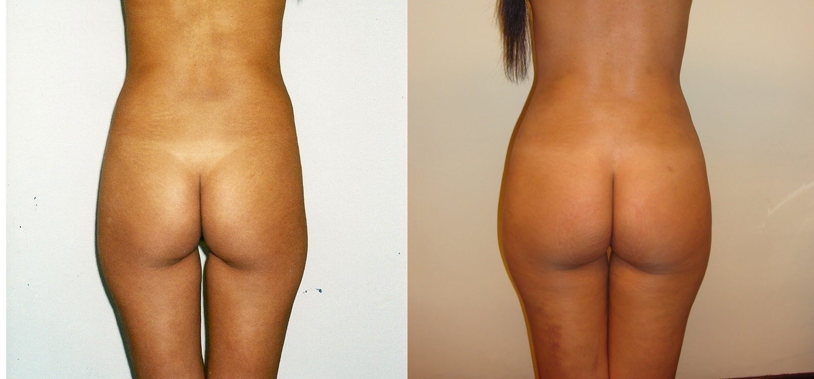 Lipoescultura y liposucción - Antes y Después