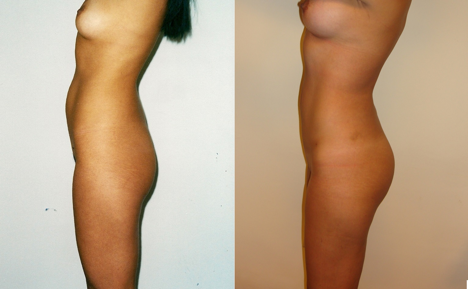 Lipoescultura y liposucción - Antes y Después