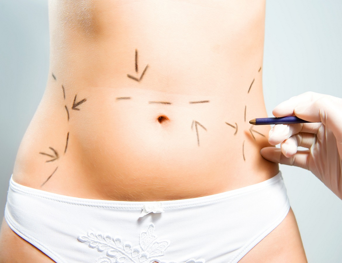 Abdominoplastia