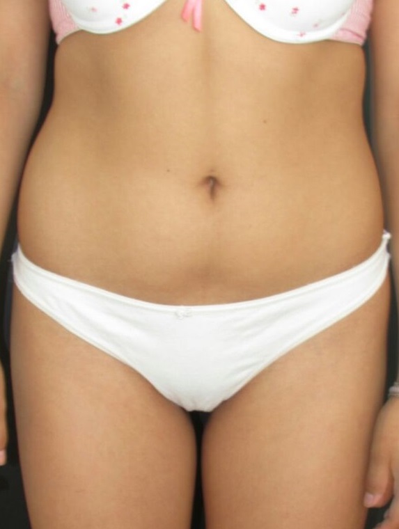 Dermolipectomía Abdominal (Abdominoplastia / Tummy Tuck) - Antes