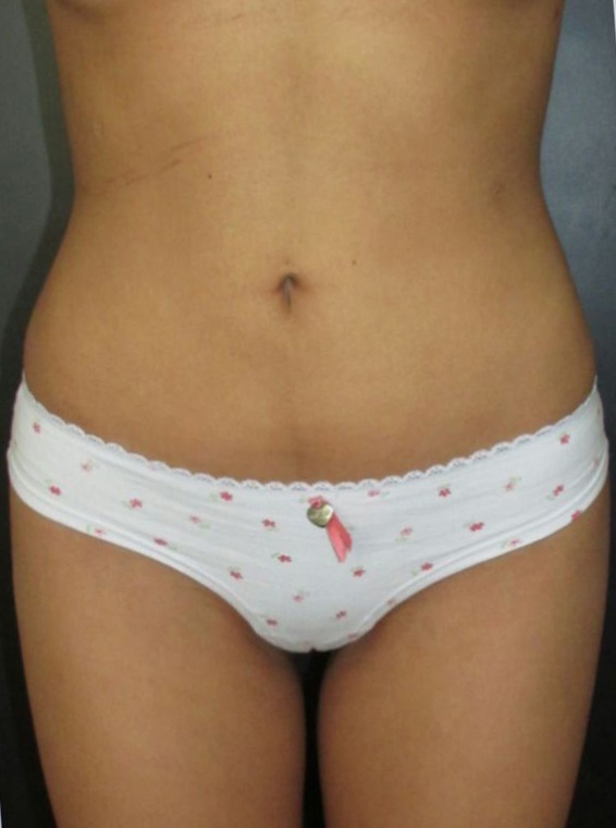 Dermolipectomía Abdominal (Abdominoplastia / Tummy Tuck) - Después