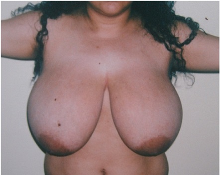 Reducción de Busto (Mamoplastia Reductora) - Antes