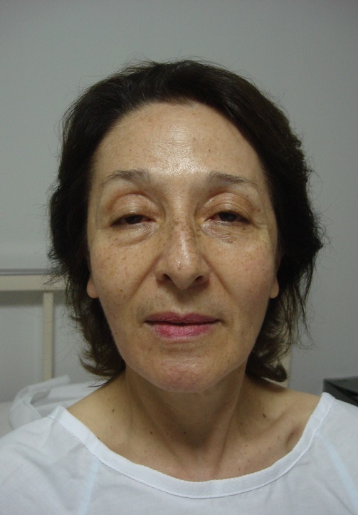 Rejuvenecimiento Facial (Facelift / Ritidectomía) - Antes