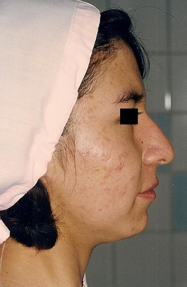 Cirugía de Nariz con Mentón (Perfiloplastia Integral) - Antes