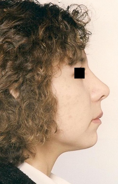Cirugía de Nariz con Mentón (Perfiloplastia Integral) - Después