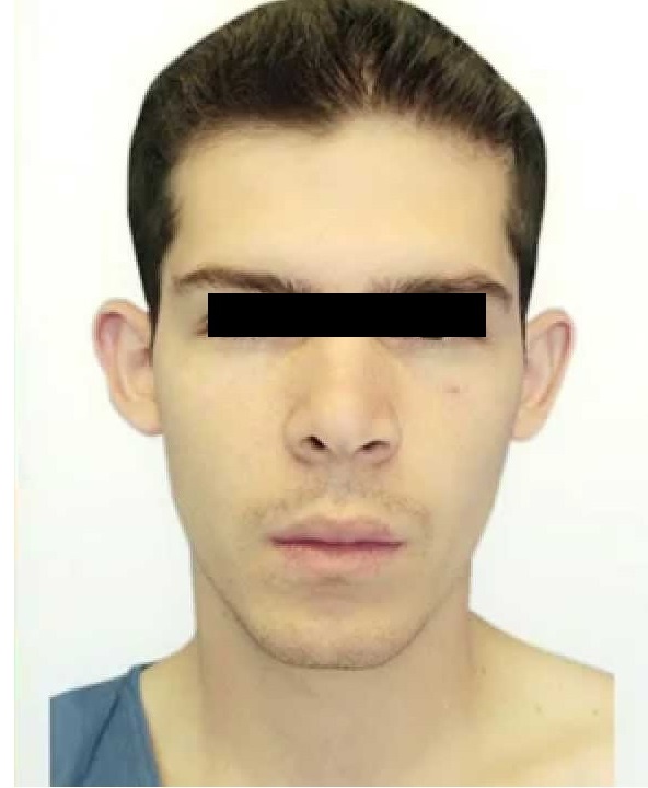 Cirugía de Orejas (Otoplastia) - Después