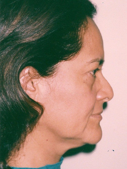 Cirugía de Párpados (Blefaroplastia Superior e Inferior) - Antes