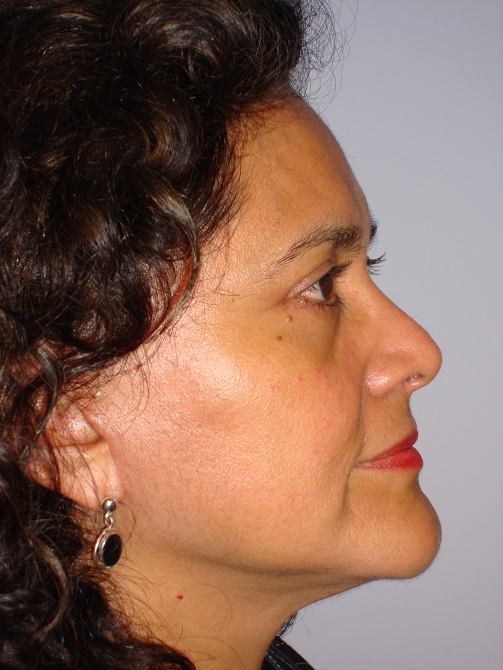 Cirugía de Párpados (Blefaroplastia Superior e Inferior) - Después