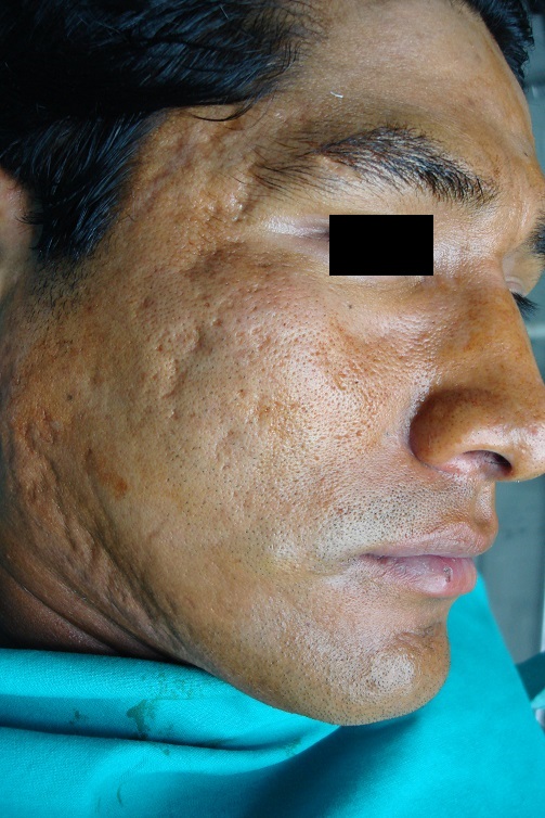 Peeling Mecánico y Dermoabrasión Quirúrgica - Antes