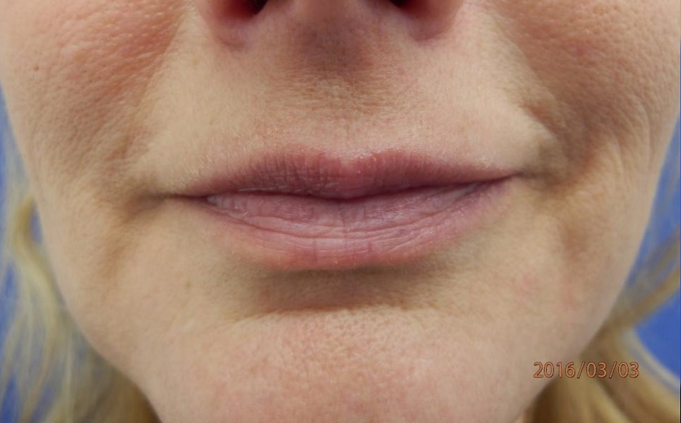 Cirugía de Labios (Queiloplastia y Lip Lift) - Antes