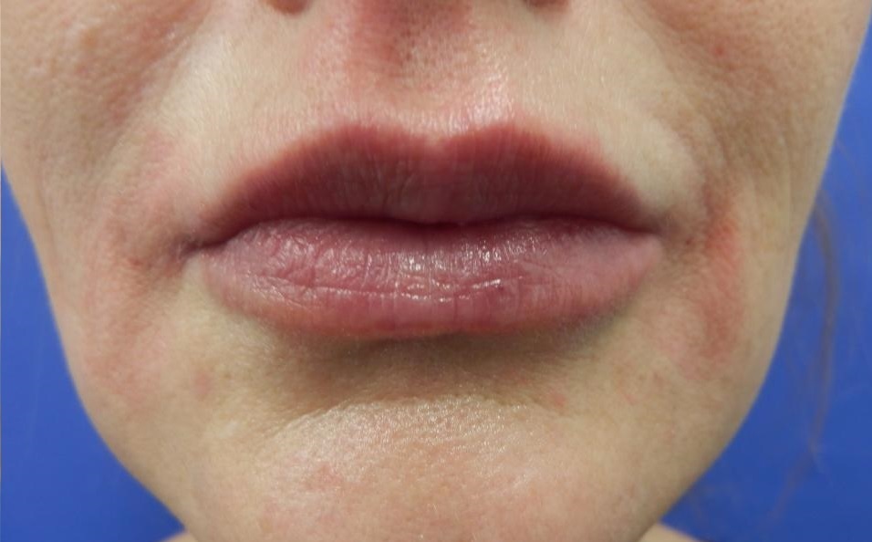 Cirugía de Labios (Queiloplastia y Lip Lift) - Después