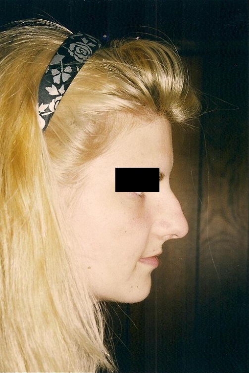 Cirugía de Nariz (Rinoplastia Estética y Funcional) - Antes