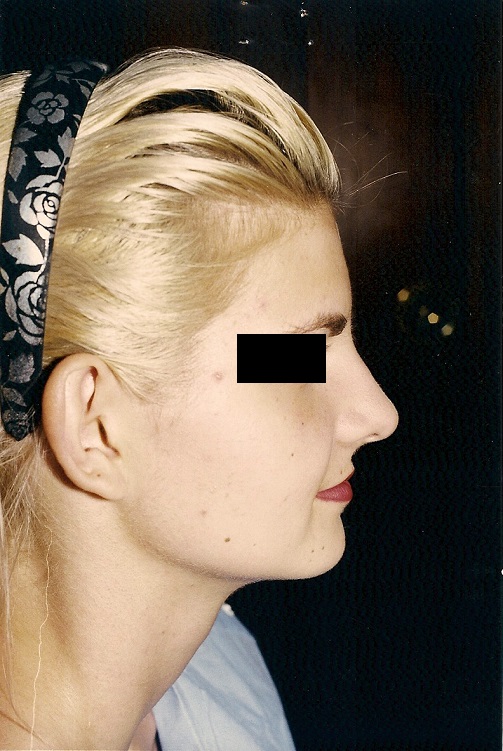 Cirugía de Nariz (Rinoplastia Estética y Funcional) - Después
