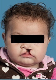 Fisura Labial (Labio Leporino / Queiloplastia Reconstructiva) - Antes