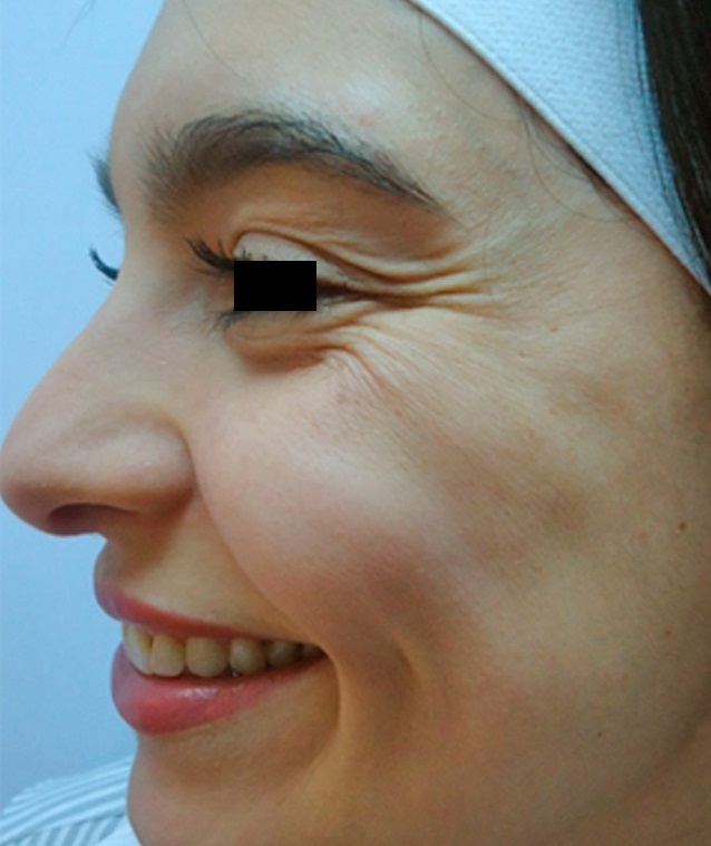 Medicina Cosmética y Estética Facial Avanzada - Antes