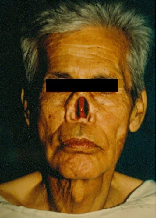 Reconstrucción Nasal Compleja - Antes