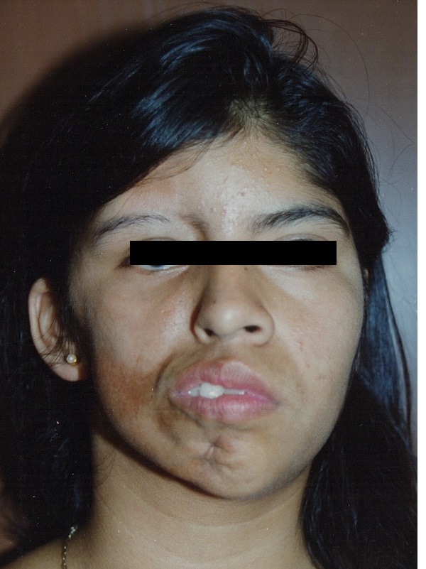 Tratamiento del Síndrome de Parry Romberg (Hemiatrofia Facial) - Antes