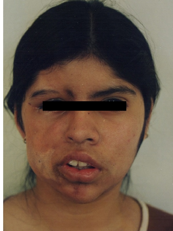 Tratamiento del Síndrome de Parry Romberg (Hemiatrofia Facial) - Después