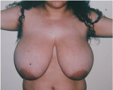 Before-Reducción de senos