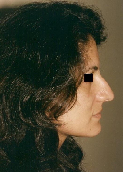 Before-Rinoplastia